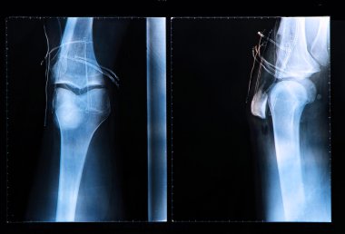 X-Ray image if the human knee clipart