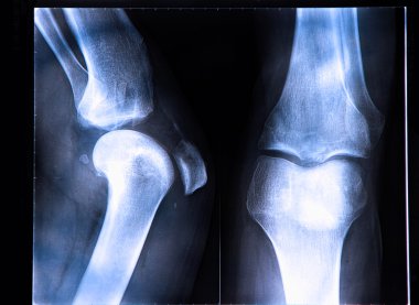 X-Ray image if the human knee clipart
