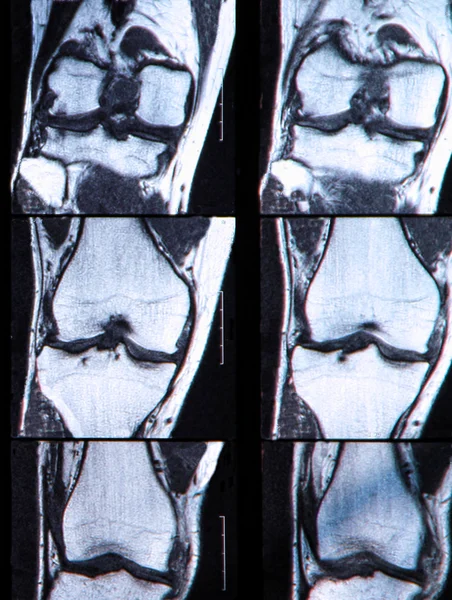 Imagen de rayos X si la rodilla humana — Foto de Stock