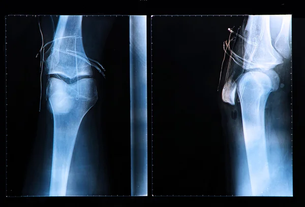 X 선 영상 경우 인간의 무릎 스톡 이미지