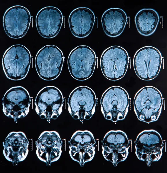 磁共振成像大脑扫描 — 图库照片