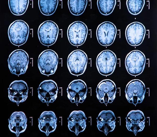 MRI hersenscan — Stockfoto