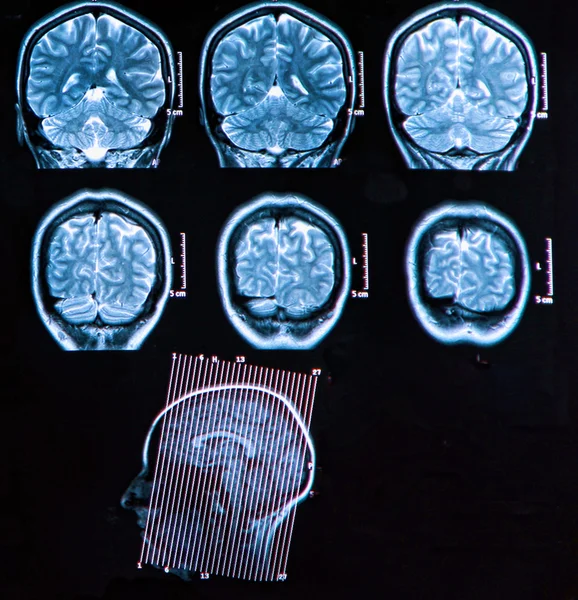 Mri Brain Scan — Stock Photo, Image