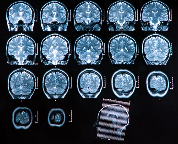 Mri Brain Scan — Stock Photo, Image