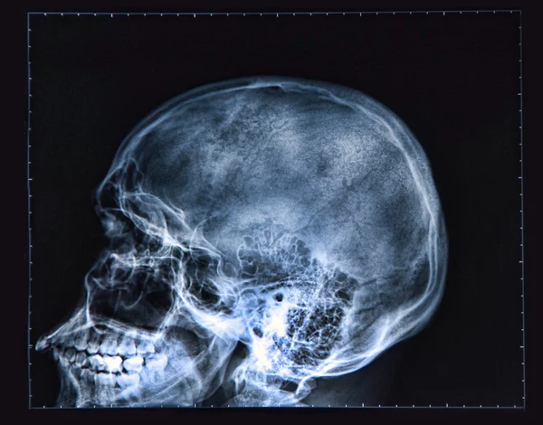 Рентгеновский снимок головы — стоковое фото