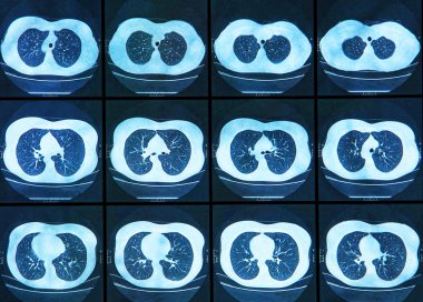 MRI tarama insan akciğer