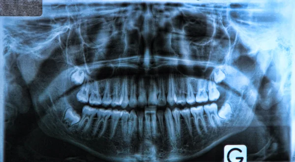 Panoramic dental x-ray — Stock Photo, Image