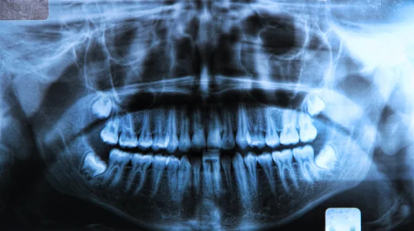 Πανοραμική οδοντιατρική ακτινογραφία Royalty Free Εικόνες Αρχείου