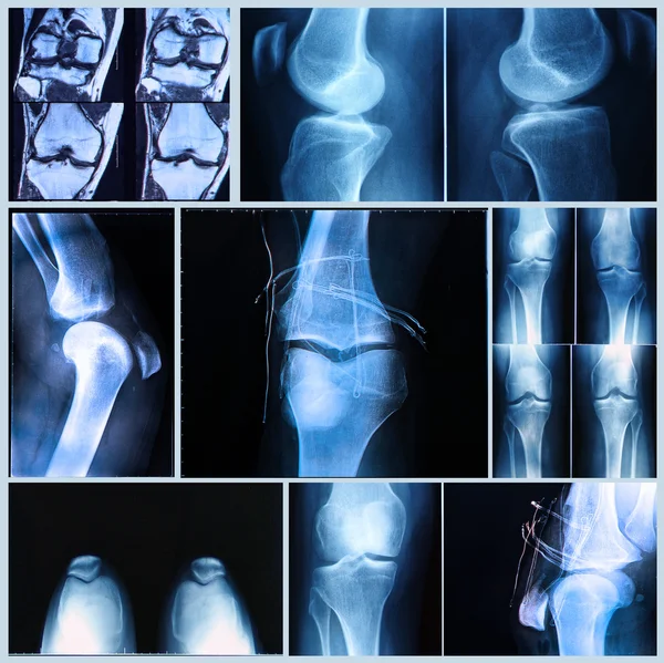 무릎 검사: x-선 및 Mri 스캔 스톡 사진