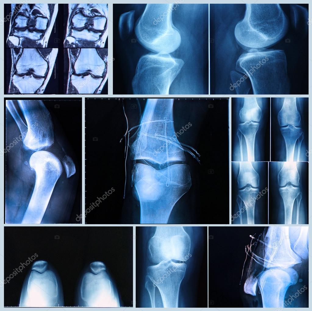 Knee medical exam Xray and MRI scan ⬇ Stock Photo, Image by