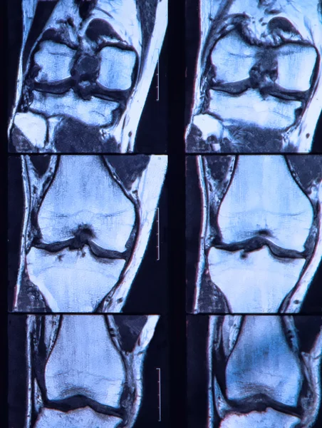 Rozerwanie więzadła krzyżowego przedniego na mri kolana. — Zdjęcie stockowe