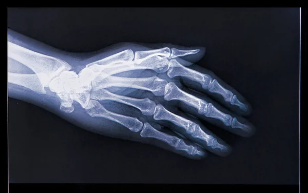 X-ray van menselijke hand — Stockfoto