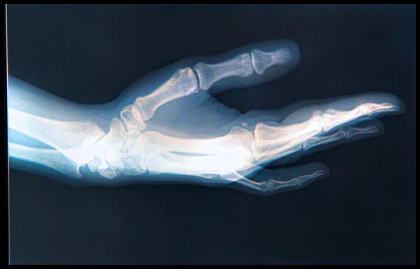 Röntgenbild av mänsklig hand — Stockfoto