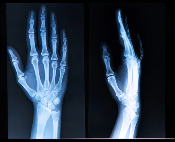 Röntgenbild der menschlichen Hand Stockfoto