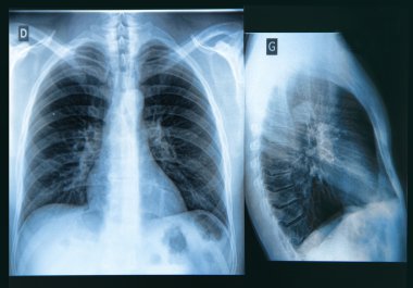 Chest X-ray Image clipart