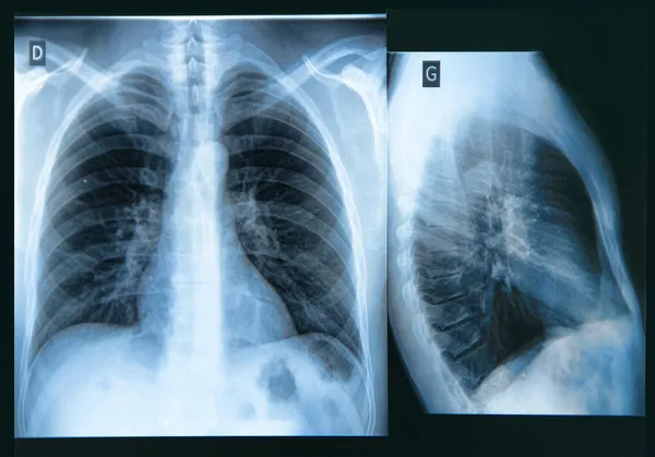 Röntgenbild der Brust Stockbild