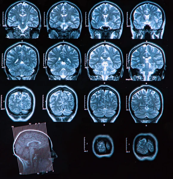 MRI Escaneamento cerebral — Fotografia de Stock