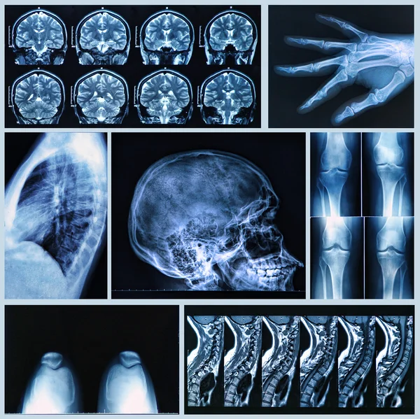 Radiografía de Huesos Humanos — Foto de Stock