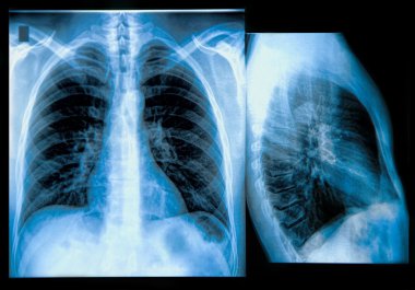 Chest X-ray Image clipart