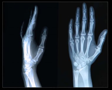 Xray el ve parmak