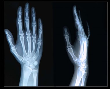 Xray el ve parmak