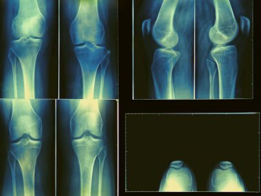 Knee x-ray clipart