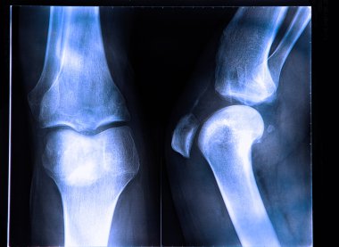 Knee x-ray clipart