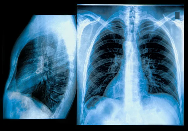Zdjęcie rentgenowskie klatki piersiowej — Zdjęcie stockowe