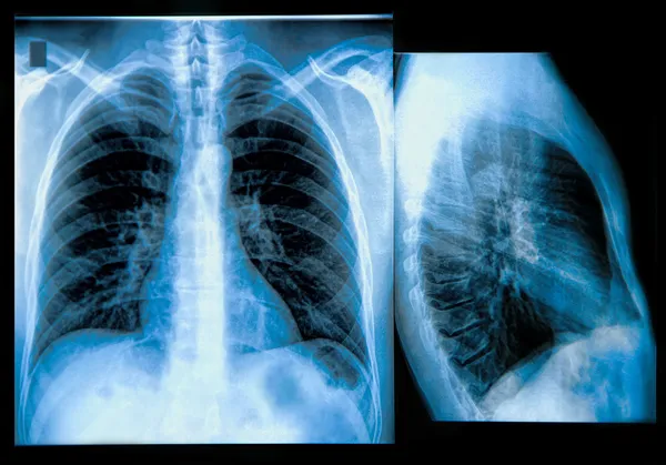 Göğüs röntgeni görüntü — Stok fotoğraf