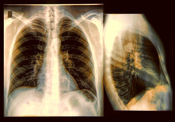 Zdjęcie rentgenowskie klatki piersiowej — Zdjęcie stockowe