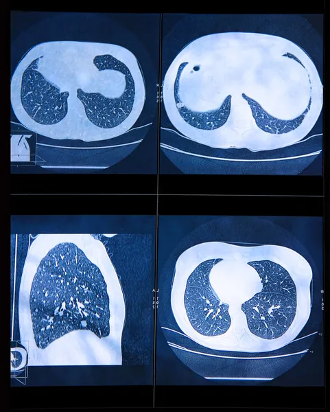 Mr-undersökning av de mänskliga lungorna — Stockfoto