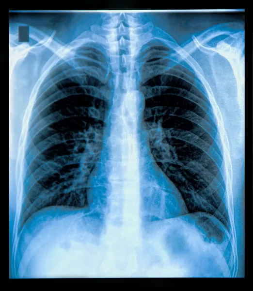 Hrudníku x-ray obraz — Stock fotografie