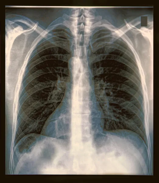 Radiografia de tórax — Fotografia de Stock