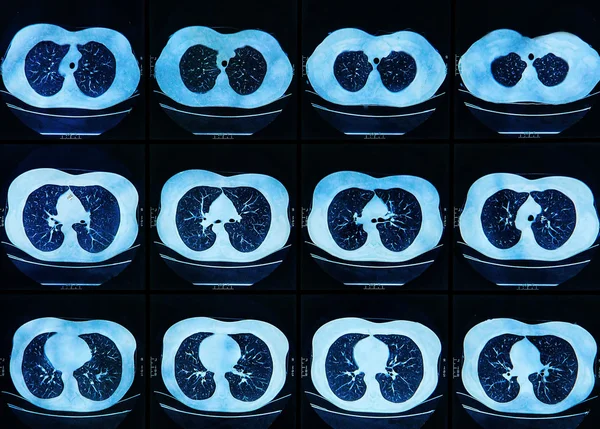 Mri scan der menschlichen Lungen — Stockfoto