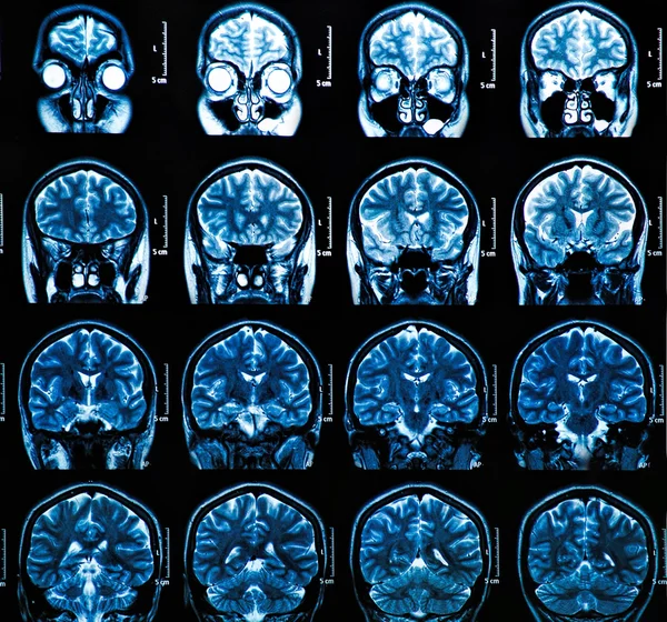 MRI Brain Scan — Stock Photo, Image