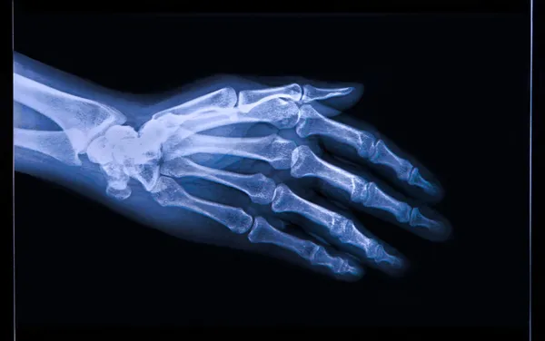 Xray of Hand and fingers — Stock Photo, Image