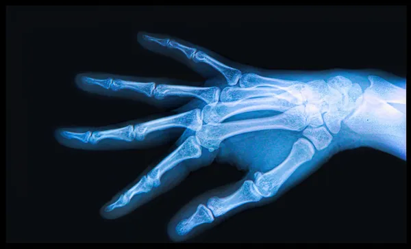 Raio-X da mão e dos dedos — Fotografia de Stock
