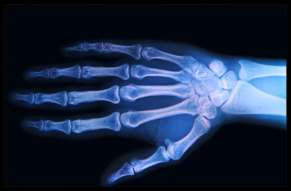 Xray of Hand and fingers — Stock Photo, Image