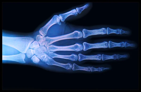 Xray of Hand and fingers — Stock Photo, Image