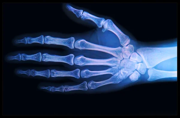 Xray of Hand and fingers — Stock Photo, Image