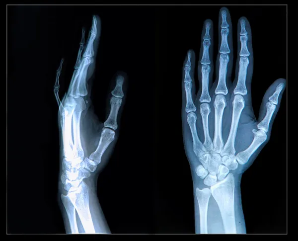 Xray of Hand and fingers — Stock Photo, Image