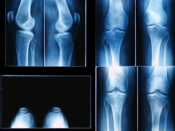 Рентген колена — стоковое фото