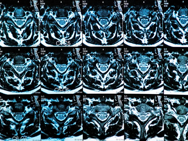 MRI c kręgosłup — Zdjęcie stockowe