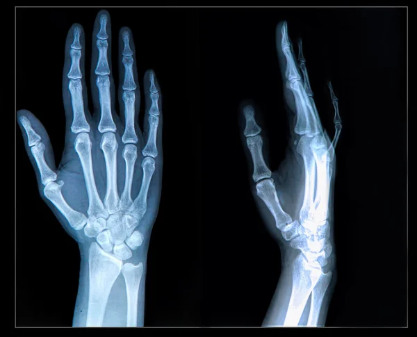 Xray of Hand and fingers — Stock Photo, Image