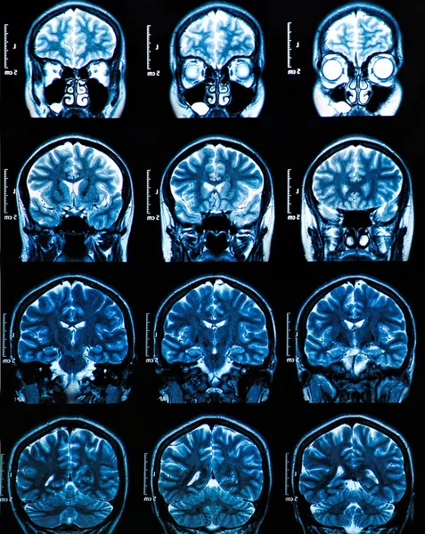 Resonancia magnética cerebral Imagen de archivo