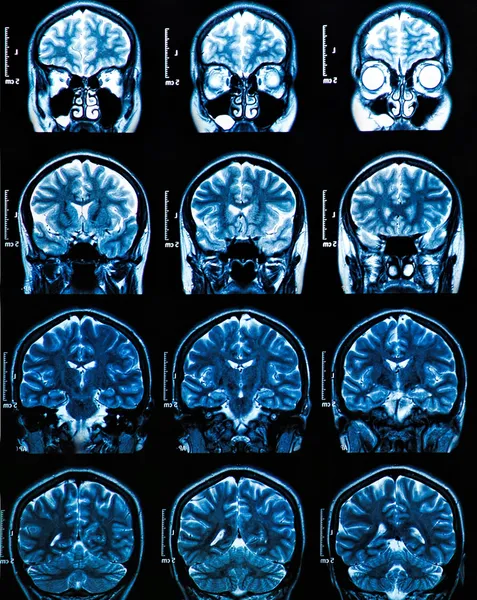 Mri 뇌 스캔 스톡 이미지