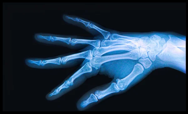 Xray van hand en vingers Stockfoto