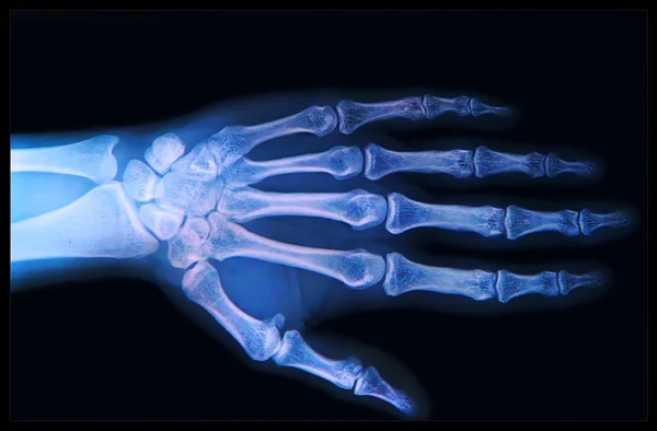 Röntgen von Hand und Fingern lizenzfreie Stockfotos