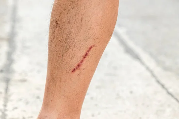 Deride Yakın Yara Izi Bacağındaki Yara Kabuk Bağlamış Sağ Bacağında — Stok fotoğraf