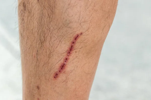 紧闭皮肤上的疤痕 伤口是腿上的斑斑 右腿有长刺伤的人 — 图库照片